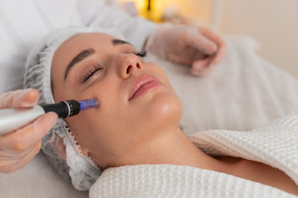 Microagulhamento facial em Sorocaba